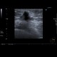 Breast carcinoma: US - Ultrasound